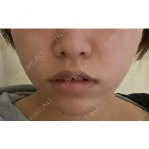 脂肪吸引（顔） アサミ美容外科 大阪院 AFTER