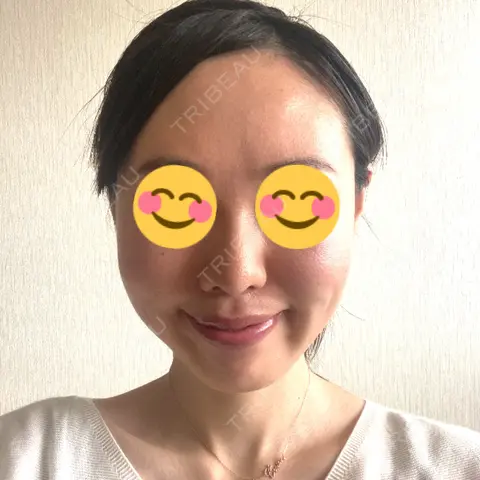 糸リフト / メーラーファット除去 WOM CLINIC GINZA （ワム クリニック ギンザ） AFTER