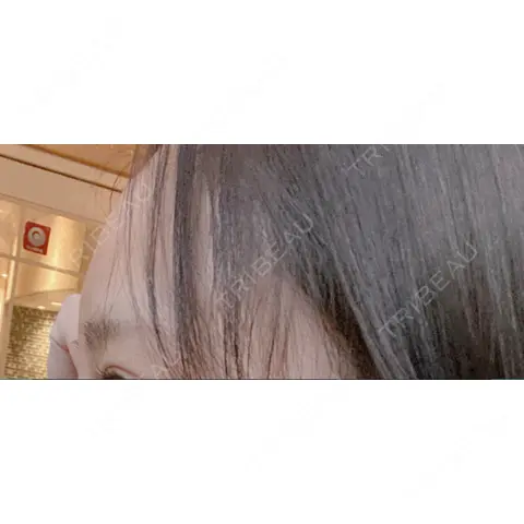 ヒアルロン酸注入（額） 恵聖会クリニック 心斎橋院 DAY 0