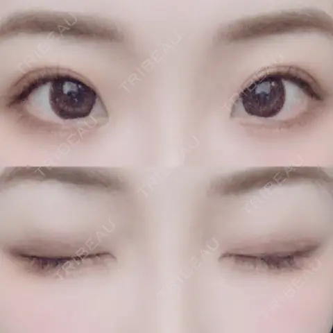 二重切開 品川美容外科 千葉院 AFTER