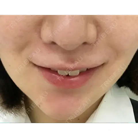 メーラーファット除去 WOM CLINIC GINZA （ワム クリニック ギンザ） AFTER