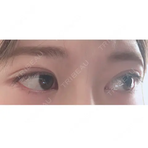 二重埋没 / 目尻切開 / タレ目形成・グラマラスライン（切開） A CLINIC（エークリニック） 銀座院 AFTER