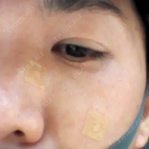 ほくろ・いぼ切除（肌） / ほくろ・いぼ除去レーザー（肌） / その他（肌） 高梨医院 皮膚科・美容皮膚科 DAY 0