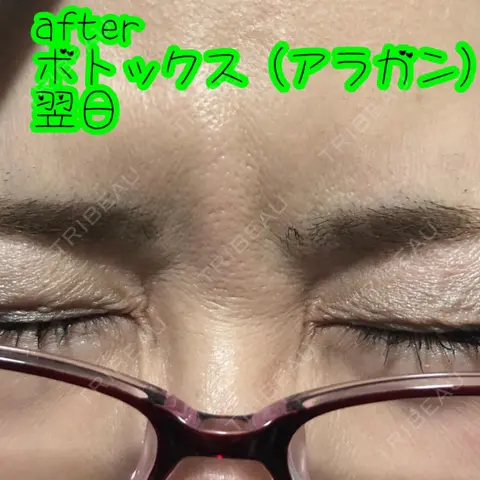 シワ取りボトックス 品川美容外科 千葉院 DAY 1