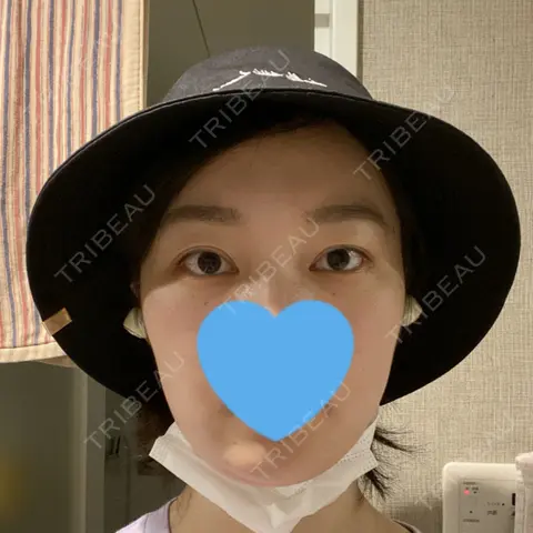 バッカルファット除去 TCB東京中央美容外科 京都駅前院 DAY 0
