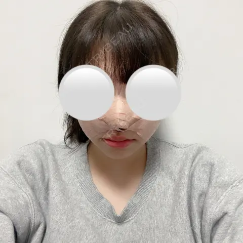 鼻尖形成（切開） / 鼻翼基部形成（貴族手術） みずほクリニック DAY 0