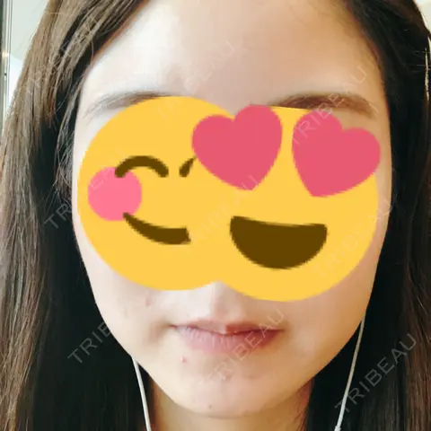骨削り（エラ） / 骨削り（頬） / 脂肪吸引（顔） View美容整形外科 AFTER