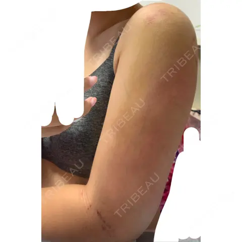脂肪吸引（二の腕） 湘南美容クリニック 千葉センシティ院 DAY 3