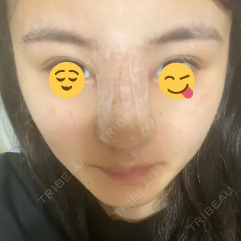 隆鼻術 湘南美容クリニック 岡山院 DAY 0