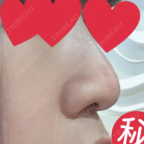 小鼻縮小（切開） / 鼻尖縮小 グレーススキンクリニック AFTER