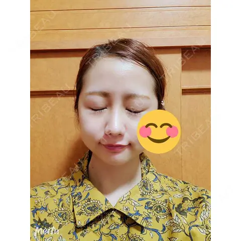 隆鼻術 / 鼻尖形成（切開） / 鼻中隔延長（切開） / 小鼻縮小（切開） / 軟骨移植  AFTER