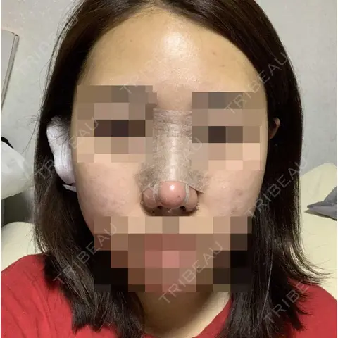 隆鼻術 / 軟骨移植 エイト美容外科 DAY 0