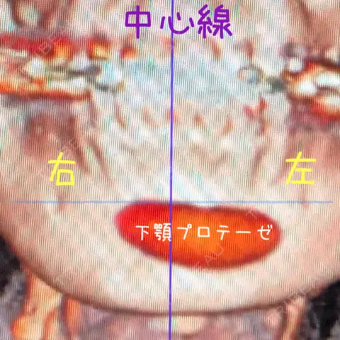 糸リフト / 額プロテーゼ 銀座TAクリニック AFTER