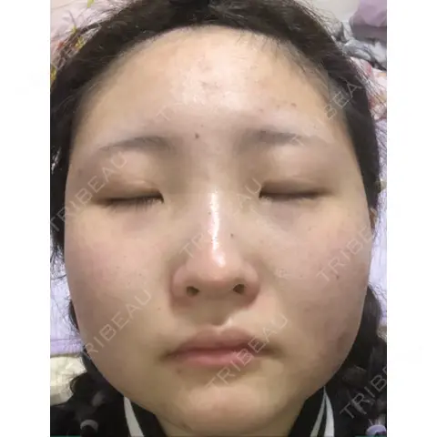 ほくろ・いぼ切除（肌） / 美肌レーザー / シミ取りレーザー / 医療脱毛（顔） / ニキビ治療 加藤病院 DAY 0