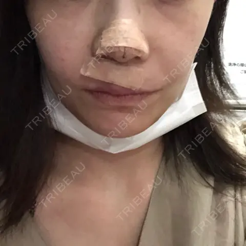 軟骨移植 / 鼻翼基部形成（貴族手術） / その他（鼻） 牧野美容クリニック DAY 0