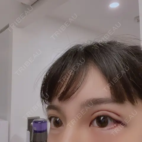 眼瞼下垂（切開） / 目尻切開 / タレ目形成・グラマラスライン（切開） 目白ポセンシアクリニック DAY 0