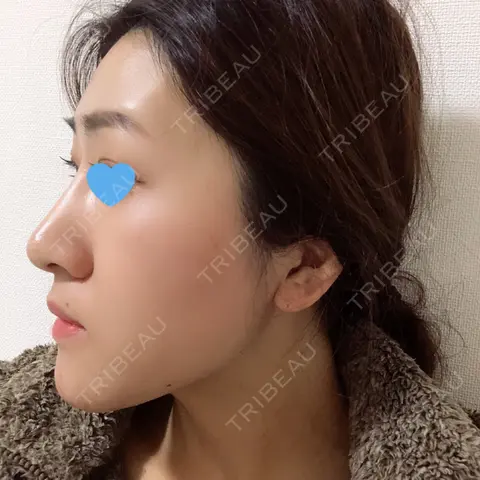 隆鼻術 / 鼻尖形成（切開） / 鼻修正 / 鼻尖縮小 / 鼻翼基部形成（貴族手術） サラ美容外科 AFTER