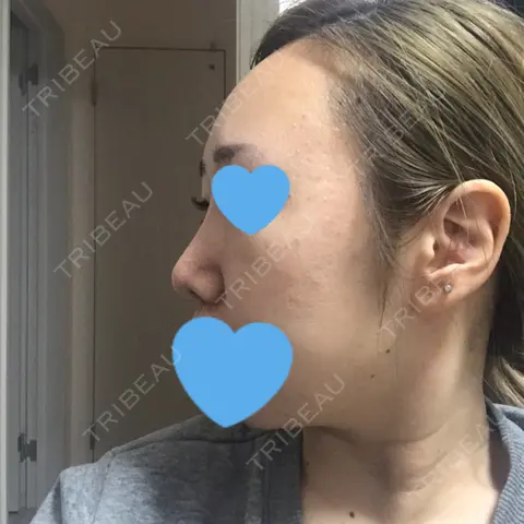 鼻尖形成（切開） / 軟骨移植 / 眉間プロテーゼ / 鼻尖縮小 湘南美容クリニック 柏院 AFTER