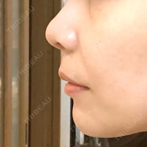 軟骨移植 / 鼻翼基部形成（貴族手術） / その他（鼻） 牧野美容クリニック AFTER