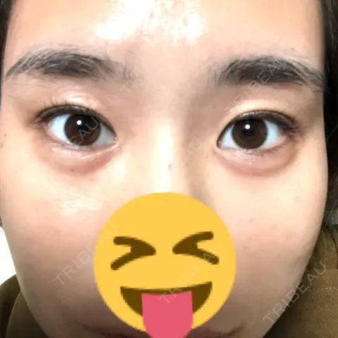 二重埋没 / 糸リフト / ヒアルロン酸注入（涙袋） / ヒアルロン酸注入（鼻） / 脂肪溶解注射（顔） / シミ取りレーザー まりもクリニック AFTER