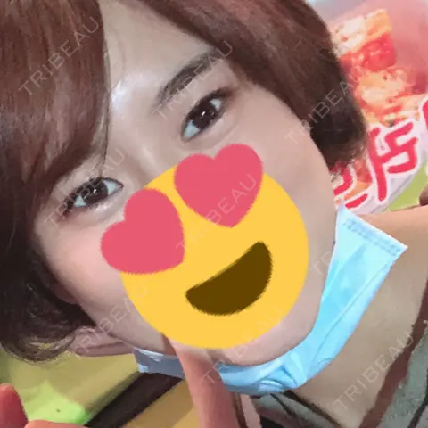 二重埋没 / 糸リフト / ヒアルロン酸注入（涙袋） / ヒアルロン酸注入（鼻） / 脂肪溶解注射（顔） / シミ取りレーザー まりもクリニック AFTER