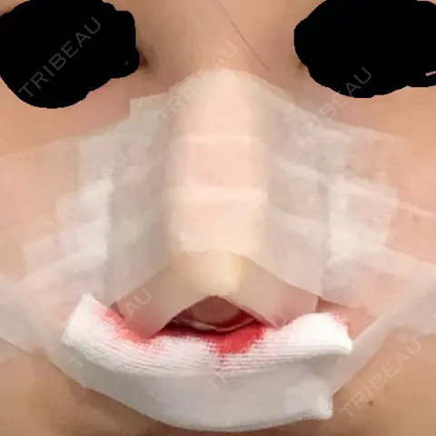 鼻尖形成（切開） / 軟骨移植 / 骨切幅寄せ THE ROPPONGI CLINIC（ザ 六本木クリニック） DAY 0