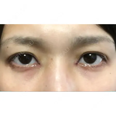 蒙古ひだ形成 R.O.clinic DAY 0