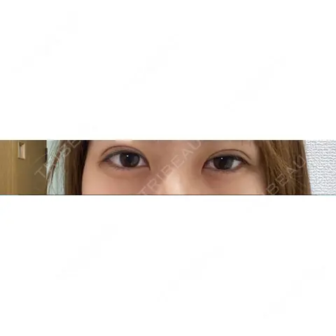 二重埋没 ながしまクリニック DAY 0