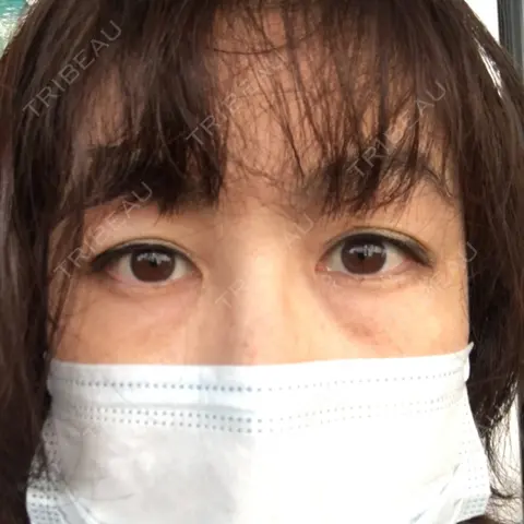 下まぶたの脂肪取り セオリークリニック AFTER