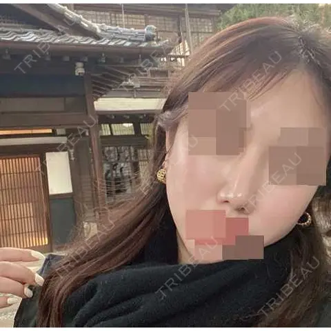 隆鼻術 / 軟骨移植 エイト美容外科 AFTER