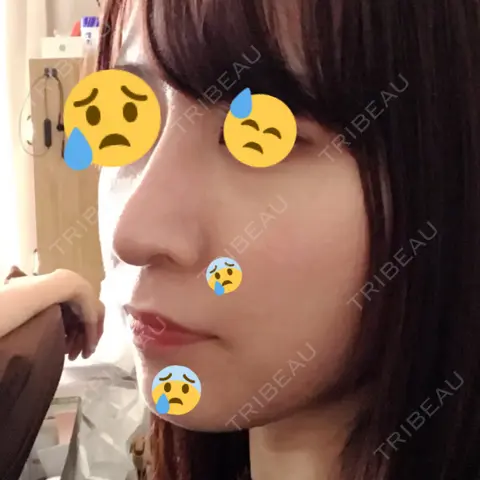 隆鼻術 / 鼻尖形成（切開） / 軟骨移植 / 鼻修正 湘南美容クリニック 柏院 AFTER
