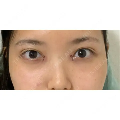 目頭切開 OZI SKIN CLINIC（オジスキンクリニック） DAY 0