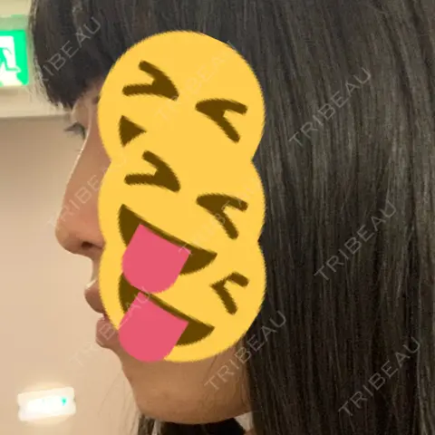 その他（鼻） 聖心美容クリニック 大阪院 DAY 0
