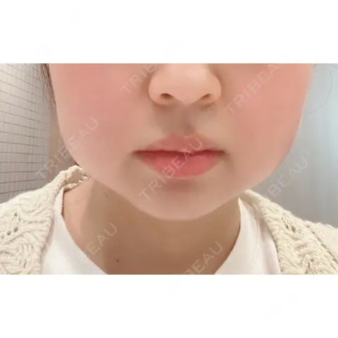 脂肪溶解注射（顔） / ハイフ（顔） TCB東京中央美容外科 中野院 DAY 0