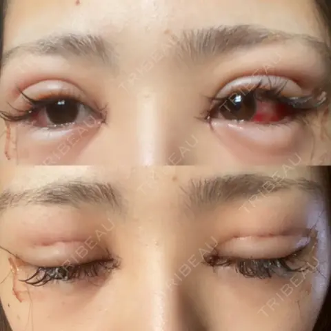 二重埋没 / 目頭切開 / 目尻切開 / タレ目形成・グラマラスライン（切開） A CLINIC（エークリニック） 銀座院 DAY 2