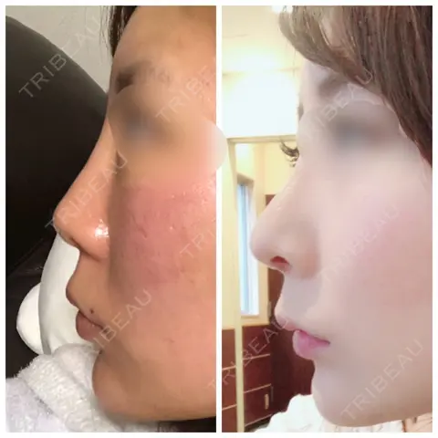鼻尖形成（切開） / 鼻中隔延長（切開） / 軟骨移植 / 鼻翼基部形成（貴族手術） HANABI整形外科 AFTER