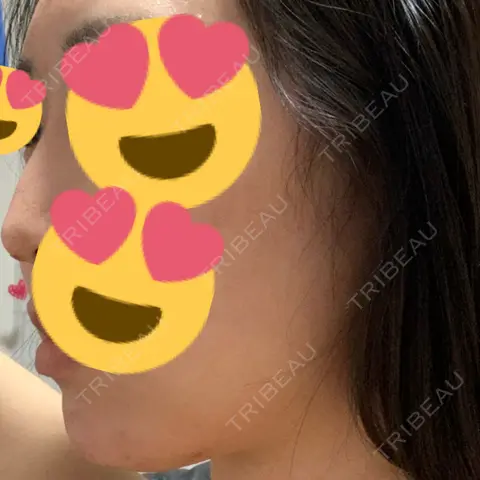 ヒアルロン酸注入（あご） 聖心美容クリニック 大阪院 DAY 0