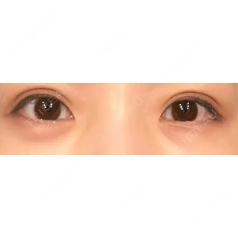 下まぶたの脂肪取り ながしまクリニック AFTER