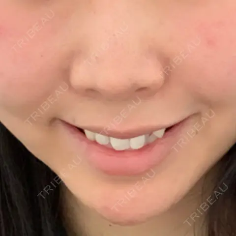 ガミースマイル手術 / 口角挙上 / ボトックス（口角） / その他（口元） 水の森美容クリニック 大阪院 AFTER