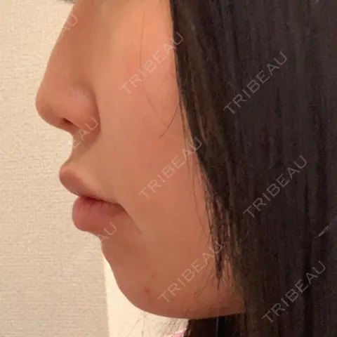 ヒアルロン酸注入（あご） 聖心美容クリニック 大阪院 AFTER