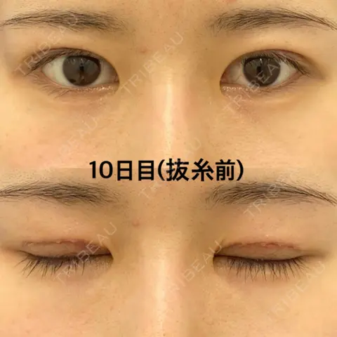 二重切開 湘南美容クリニック 高田馬場院 DAY 10