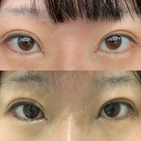 蒙古ひだ形成 R.O.clinic DAY 0