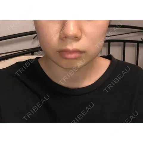糸リフト / バッカルファット除去 / ボトックス（エラ・小顔） / ヒアルロン酸注入（頬） 湘南美容クリニック 横浜院 DAY 1