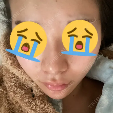 スレッドノーズ 共立美容外科 渋谷院 AFTER