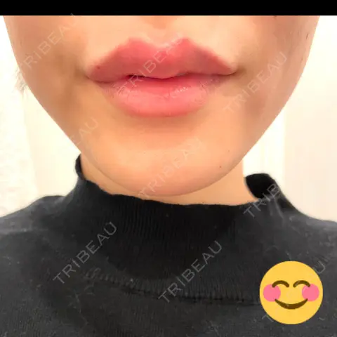 人中短縮 / ヒアルロン酸注入（唇） / ボトックス（口角） アクトリー勝どきウェルネスメディカルクリニック DAY 0