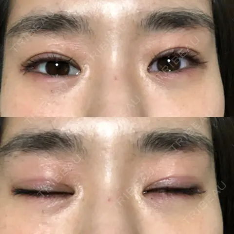 目尻切開 / タレ目形成・グラマラスライン（切開） サラ美容外科 DAY 0