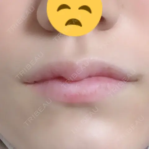 口角挙上 / ヒアルロン酸注入（唇） まりもクリニック AFTER