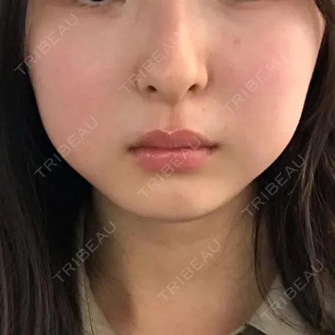脂肪溶解注射（顔） 湘南美容クリニック 岡山院 DAY 0