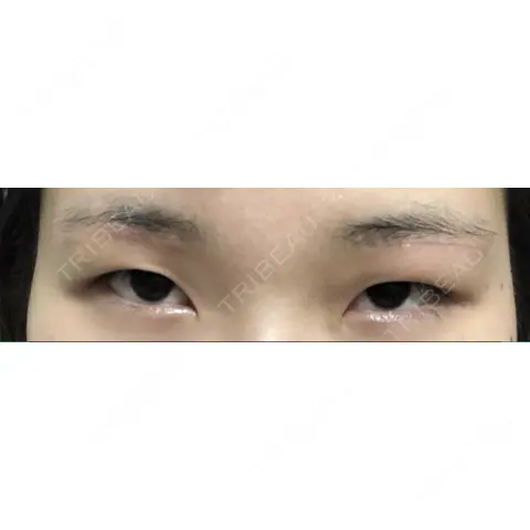 眉下切開 聖心美容クリニック 六本木院 AFTER
