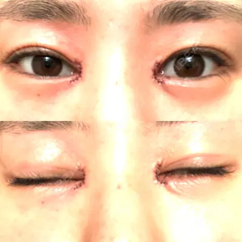 目頭切開 まりもクリニック DAY 0